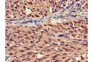 Immunohistochemistry of paraffin-embedded human lung cancer using ABIN7170803 at dilution of 1:100 (STOML3 Antikörper  (AA 205-291))