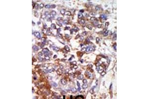 Formalin-fixed and paraffin-embedded human cancer tissue reacted with the primary antibody, which was peroxidase-conjugated to the secondary antibody, followed by AEC staining. (PRKG1 Antikörper  (C-Term))