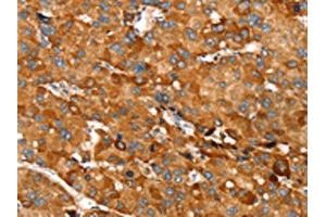 The image on the left is immunohistochemistry of paraffin-embedded Human liver cancer tissue using ABIN7130896(RNF14 Antibody) at dilution 1/20, on the right is treated with fusion protein.