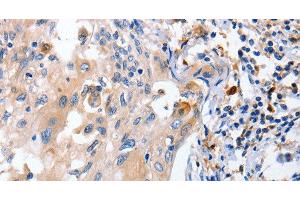 Immunohistochemistry of paraffin-embedded Human cervical cancer using IL18 Polyclonal Antibody at dilution of 1:100 (IL-18 Antikörper)