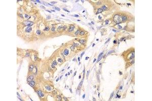 Immunohistochemistry of paraffin-embedded Human liver cancer using HAGH Polyclonal Antibody at dilution of 1:100 (40x lens). (HAGH Antikörper)