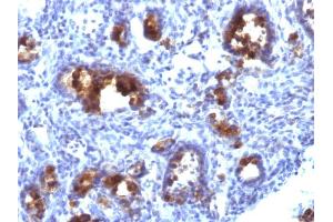Formalin-fixed, paraffin-embedded human Gastric Carcinoma stained with MUC3 Monoclonal Antibody (MUC3/1154). (MUC3A Antikörper)