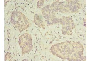 Immunohistochemistry of paraffin-embedded human gastric cancer using ABIN7142267 at dilution of 1:100 (MRPS31 Antikörper  (AA 66-395))