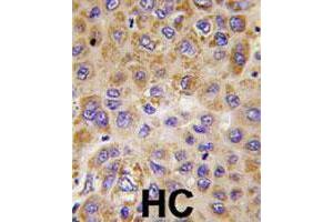 Formalin-fixed and paraffin-embedded human hepatocellular carcinoma reacted with PFKFB1 polyclonal antibody  , which was peroxidase-conjugated to the secondary antibody, followed by DAB staining. (PFKFB1 Antikörper  (Internal Region))