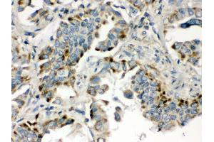 Anti- BMP5 Picoband antibody, IHC(P) IHC(P): Human Lung Cancer Tissue (BMP5 Antikörper  (C-Term))