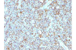 Formalin-fixed, paraffin-embedded human Ewing's Sarcoma stained with CD99 Rabbit Recombinant Monoclonal Antibody (MIC2/1495R). (Rekombinanter CD99 Antikörper)
