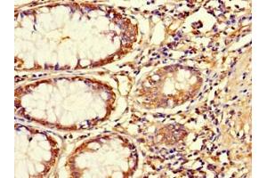 Immunohistochemistry of paraffin-embedded human colon cancer using ABIN7144761 at dilution of 1:100 (Asporin Antikörper  (AA 33-380))