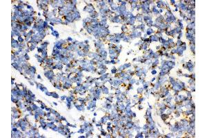 Anti- mtTFA Picoband antibody,IHC(P) IHC(P): Human Lung Cancer Tissue (TFAM Antikörper  (N-Term))