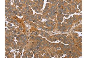 The image on the left is immunohistochemistry of paraffin-embedded Human ovarian cancer tissue using ABIN7191664(NMT1 Antibody) at dilution 1/45, on the right is treated with synthetic peptide. (NMT1 Antikörper)