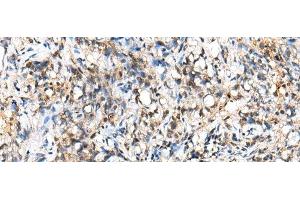 Immunohistochemistry of paraffin-embedded Human lung cancer tissue using NUDT18 Polyclonal Antibody at dilution of 1:40(x200) (NUDT18 Antikörper)