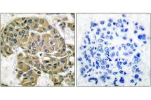 Immunohistochemistry analysis of paraffin-embedded human breast carcinoma tissue, using Mammaglobin B Antibody. (SCGB2A1 Antikörper  (AA 10-59))