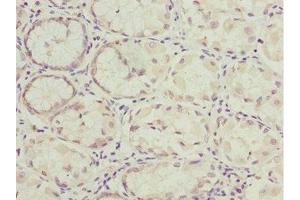 Immunohistochemistry of paraffin-embedded human gastric cancer using ABIN7161726 at dilution of 1:100 (NLE1 Antikörper  (AA 206-485))
