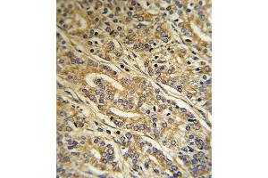 Formalin-fixed and paraffin-embedded human Prostate carcinoma reacted with ACOT8 Antibody (C-term), which was peroxidase-conjugated to the secondary antibody, followed by DAB staining. (ACOT8 Antikörper  (C-Term))