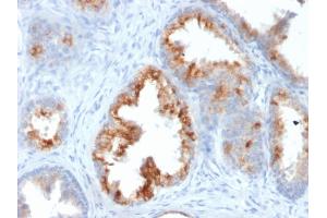 Formalin-fixed, paraffin-embedded human Prostate Carcinoma stained with AMACR / p504S Mouse Monoclonal Antibody (AMACR/1864). (AMACR Antikörper  (AA 297-394))
