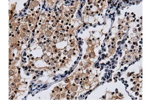 Immunohistochemical staining of paraffin-embedded Adenocarcinoma of Human breast tissue using anti-NT5DC1 mouse monoclonal antibody. (NT5DC1 Antikörper)