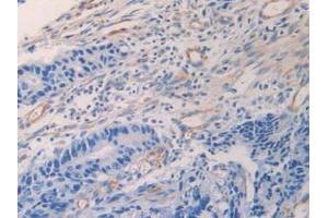 IHC-P analysis of Human Recombinant Cancer Tissue, with DAB staining.