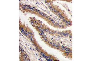 Formalin-fixed and paraffin-embedded human lung carcinoma tissue reacted with PRKX antibody , which was peroxidase-conjugated to the secondary antibody, followed by DAB staining. (PRKX Antikörper  (C-Term))