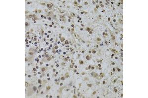 Immunohistochemistry of paraffin-embedded human liver cancer using INTS6 Antibody (ABIN2563455) at dilution of 1:100 (40x lens). (INTS6 Antikörper)