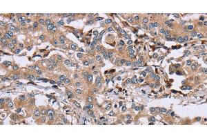 Immunohistochemistry of paraffin-embedded Human liver cancer using MAGEA3 Polyclonal Antibody at dilution of 1:50 (MAGEA3 Antikörper)