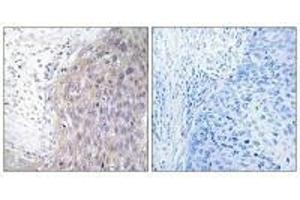 Immunohistochemistry analysis of paraffin-embedded human cervix carcinoma tissue using POLG2 antibody. (POLG2 Antikörper)