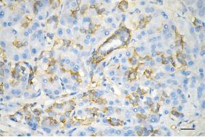 Immunohistochemistry was performed on paraffin-embedded human pancreatic adenocarcinoma using integrin subunit alpha V antibody (ABIN7800944), 1:100).