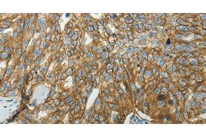 Immunohistochemistry of paraffin-embedded Human ovarian cancer tissue using SLC16A1 Polyclonal Antibody at dilution 1:50 (SLC16A1 Antikörper)