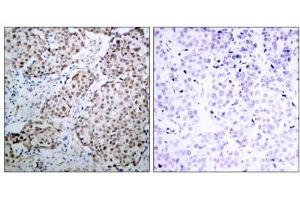 Immunohistochemical analysis of paraffin-embedded human breast carcinoma tissue using p53 (phospho- Ser315) antibody (E011100). (p53 Antikörper  (pSer315))
