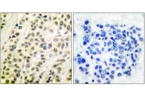 Immunohistochemistry analysis of paraffin-embedded human breast carcinoma tissue, using DP-1 Antibody. (TGM4 Antikörper  (AA 361-410))