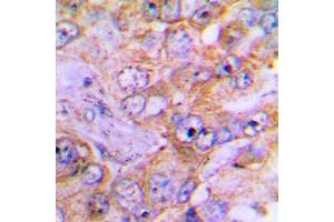 Immunohistochemical analysis of Caspase 3 staining in human lung cancer formalin fixed paraffin embedded tissue section.