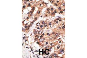 Formalin-fixed and paraffin-embedded human hepatocellular carcinoma tissue reacted with MLLT3 polyclonal antibody  , which was peroxidase-conjugated to the secondary antibody, followed by AEC staining.