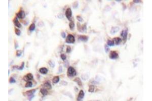 Immunohistochemistry analyzes of hnRNP C1/2 antibody in paraffin-embedded human breast carcinoma tissue. (HNRNPC Antikörper)