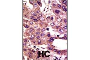 Formalin-fixed and paraffin-embedded human cancer tissue reacted with the primary antibody, which was peroxidase-conjugated to the secondary antibody, followed by DAB staining. (AMFR Antikörper  (AA 571-601))