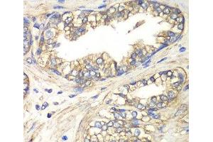 Immunohistochemistry of paraffin-embedded Human prostate using SLC4A4 / NBC Polyclonal Antibody at dilution of 1:100 (40x lens). (SLC4A4 Antikörper)