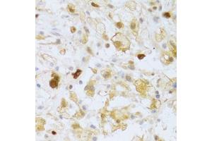Immunohistochemistry of paraffin-embedded human brain astrocytoma using FCN1 Antibody. (FCN1 Antikörper  (AA 30-326))