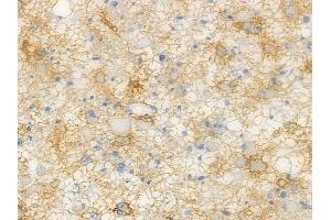 ABIN6264730 and ABIN6272560 at 1/100 staining human astrocytoma by IHC-P. (RHCG Antikörper  (C-Term))