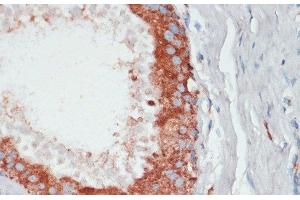 Immunohistochemistry of paraffin-embedded Human mammary cancer using PGK2 Polyclonal Antibody at dilution of 1:100 (40x lens). (PGK2 Antikörper)