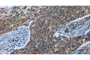 Immunohistochemistry of paraffin-embedded Human cervical cancer tissue using SYT3 Polyclonal Antibody at dilution 1:40 (Synaptotagmin 3 Antikörper)