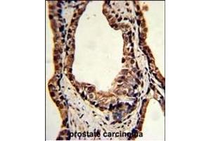 Formalin-fixed and paraffin-embedded human prostate carcinoma reacted with TPI1 Antibody (C-term), which was peroxidase-conjugated to the secondary antibody, followed by DAB staining. (TPI1 Antikörper  (C-Term))