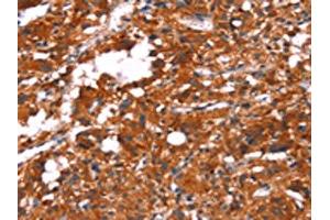 The image on the left is immunohistochemistry of paraffin-embedded Human thyroid cancer tissue using ABIN7190641(FEM1A Antibody) at dilution 1/20, on the right is treated with synthetic peptide. (FEM1A Antikörper)