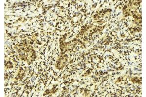 ABIN6278125 at 1/100 staining Human breast cancer tissue by IHC-P. (UNG Antikörper  (Internal Region))