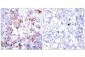 Immunohistochemical analysis of paraffin- embedded human breast carcinoma tissue using ATF-2 (Ab-69 or 51) antibody(E021030). (ATF2 Antikörper)