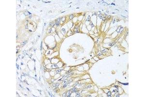 Immunohistochemistry of paraffin-embedded Human colon carcinoma using GNAI3 Polyclonal Antibody at dilution of 1:100 (40x lens). (GNAI3 Antikörper)