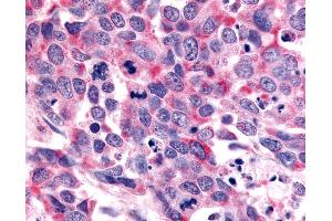 Anti-OR6K3 antibody IHC of human Lung, Small Cell Carcinoma. (OR6K3 Antikörper  (N-Term))