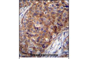 COX7A2L Antibody (Center) (ABIN656272 and ABIN2845583) immunohistochemistry analysis in formalin fixed and paraffin embedded human breast carcinoma followed by peroxidase conjugation of the secondary antibody and DAB staining. (COX7A2L Antikörper  (AA 37-65))
