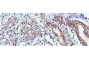 Immunohistochemical analysis of paraffin-embedded human gastric cancer (left) and normal gastric tissues (right) using CER1 antibody with DAB staining. (CER1 Antikörper)