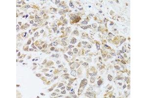 Immunohistochemistry of paraffin-embedded Human lung cancer using RNASEL Polyclonal Antibody at dilution of 1:100 (40x lens). (RNASEL Antikörper)