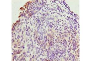 Immunohistochemistry of paraffin-embedded human bladder cancer using ABIN7173219 at dilution of 1:100 (TMEM43 Antikörper  (AA 80-310))