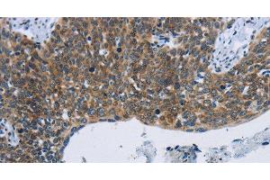 Immunohistochemistry of paraffin-embedded Human cervical cancer tissue using KPNB1 Polyclonal Antibody at dilution 1:40 (KPNB1 Antikörper)