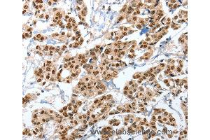 Immunohistochemistry of Human liver cancer using ANXA10 Polyclonal Antibody at dilution of 1:35 (Annexin a10 Antikörper)