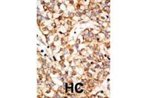 Formalin-fixed and paraffin-embedded human hepatocellular carcinoma tissue reacted with the APOBEC1 polyclonal antibody  , which was peroxidase-conjugated to the secondary antibody, followed by DAB staining. (APOBEC1 Antikörper  (N-Term))